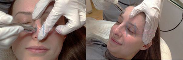 Microdermabrasion Treatment