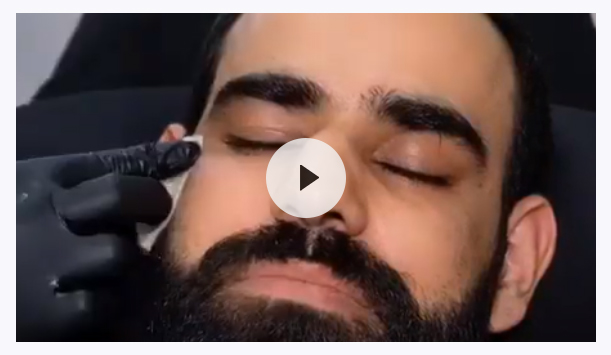 Vampire facelift | PRP Skin Facial Therapy | CosmeDocs